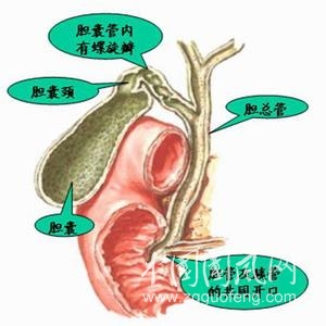 多發(fā)性膽囊息肉的原因及病發(fā)癥狀