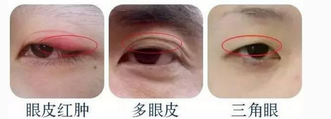 貼雙眼皮的危害