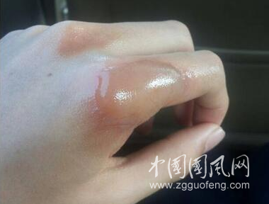 被油燙傷、燒傷怎么辦?
